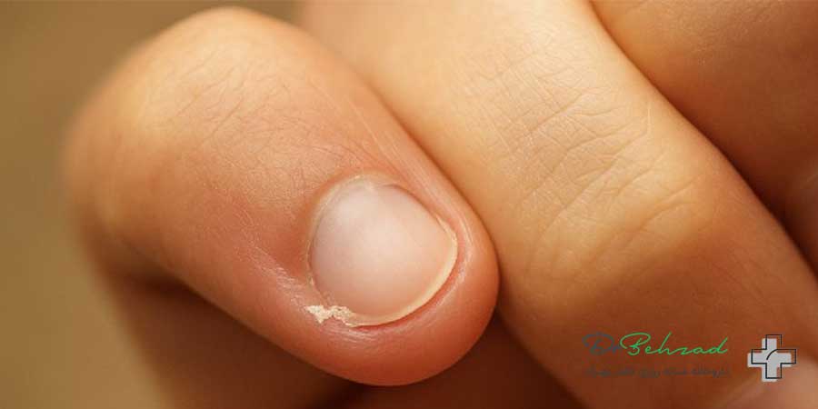 کمبود کدام ویتامین باعث پوسته شدن اطراف ناخن میشود؟ 3 علائم پوسته شدن اطراف ناخن ناشی از کمبود ویتامین چیست؟